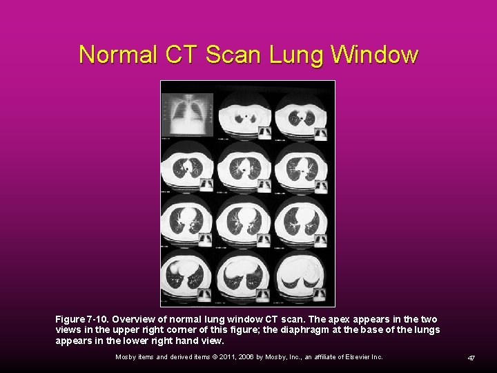 Normal CT Scan Lung Window Figure 7 -10. Overview of normal lung window CT