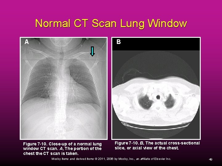 Normal CT Scan Lung Window A B Figure 7 -10. Close-up of a normal