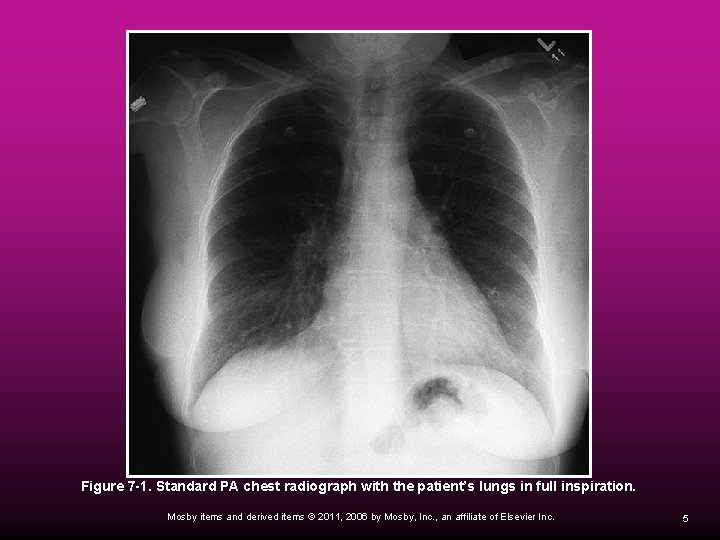  Figure 7 -1. Standard PA chest radiograph with the patient’s lungs in full