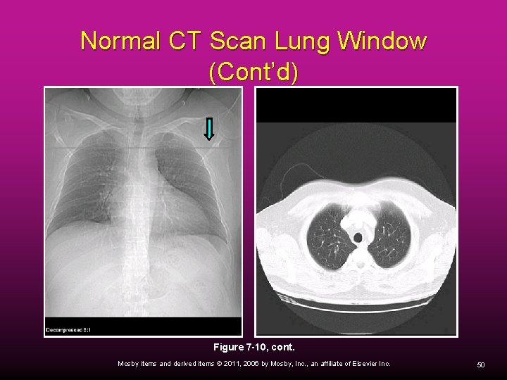 Normal CT Scan Lung Window (Cont’d) Figure 7 -10, cont. Mosby items and derived