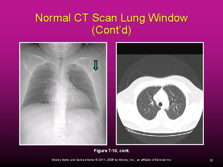 Normal CT Scan Lung Window (Cont’d) Figure 7 -10, cont. Mosby items and derived