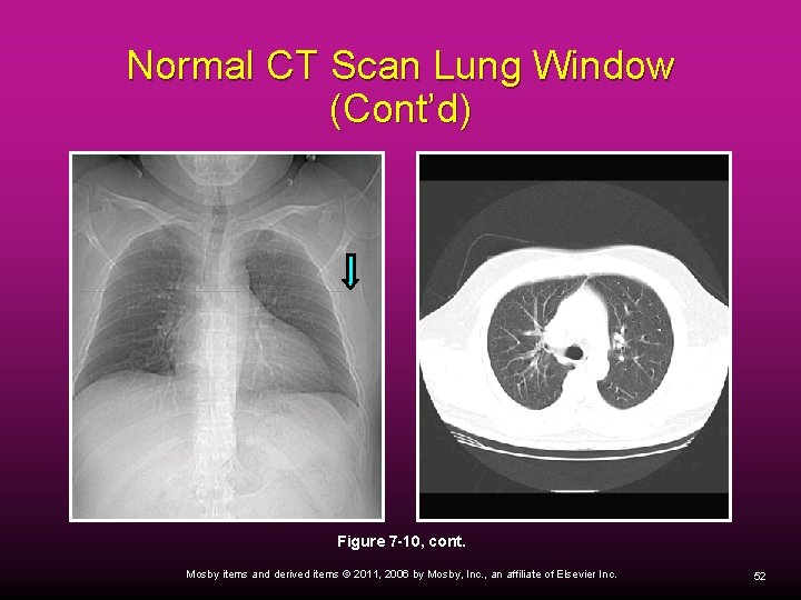 Normal CT Scan Lung Window (Cont’d) Figure 7 -10, cont. Mosby items and derived