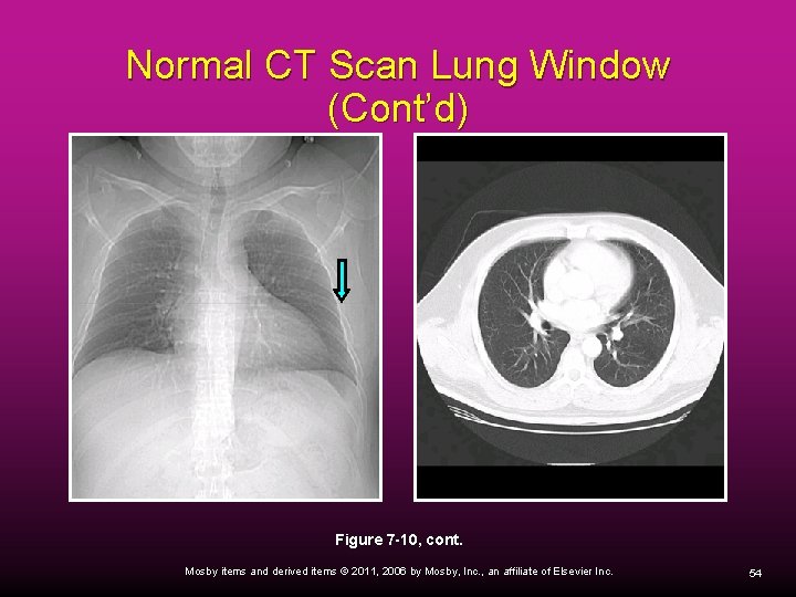 Normal CT Scan Lung Window (Cont’d) Figure 7 -10, cont. Mosby items and derived