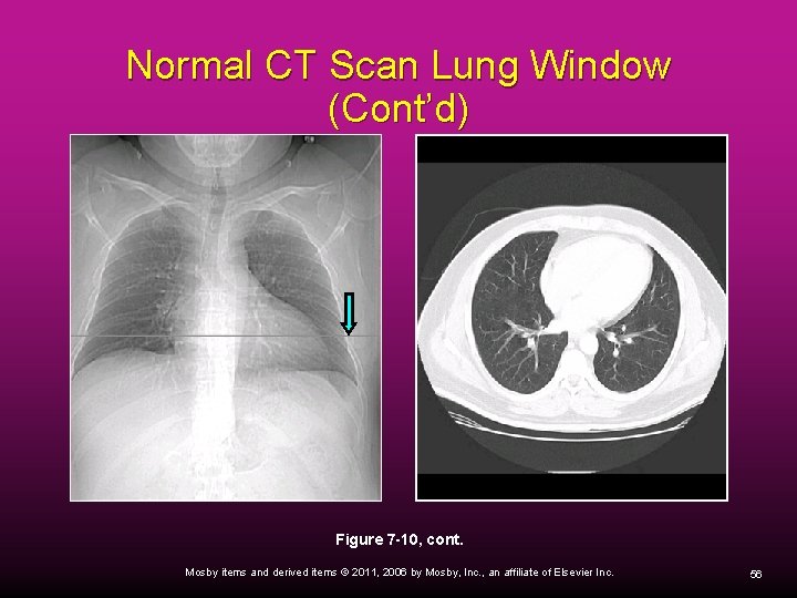 Normal CT Scan Lung Window (Cont’d) Figure 7 -10, cont. Mosby items and derived