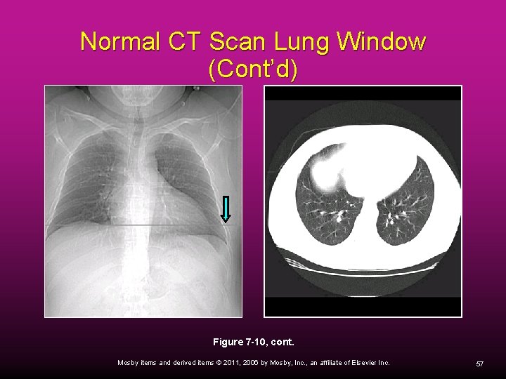 Normal CT Scan Lung Window (Cont’d) Figure 7 -10, cont. Mosby items and derived