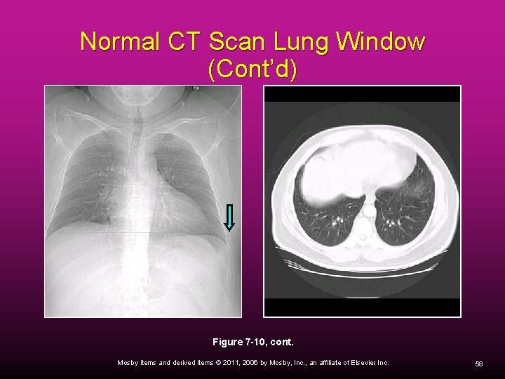 Normal CT Scan Lung Window (Cont’d) Figure 7 -10, cont. Mosby items and derived