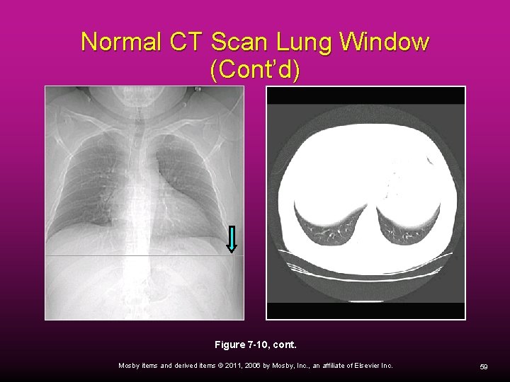 Normal CT Scan Lung Window (Cont’d) Figure 7 -10, cont. Mosby items and derived