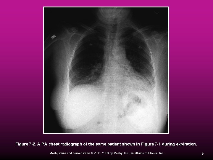 Figure 7 -2. A PA chest radiograph of the same patient shown in Figure