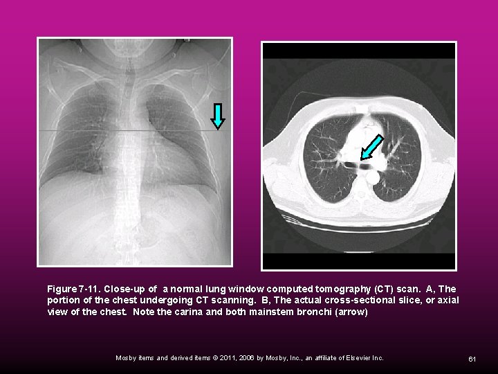 Figure 7 -11. Close-up of a normal lung window computed tomography (CT) scan. A,