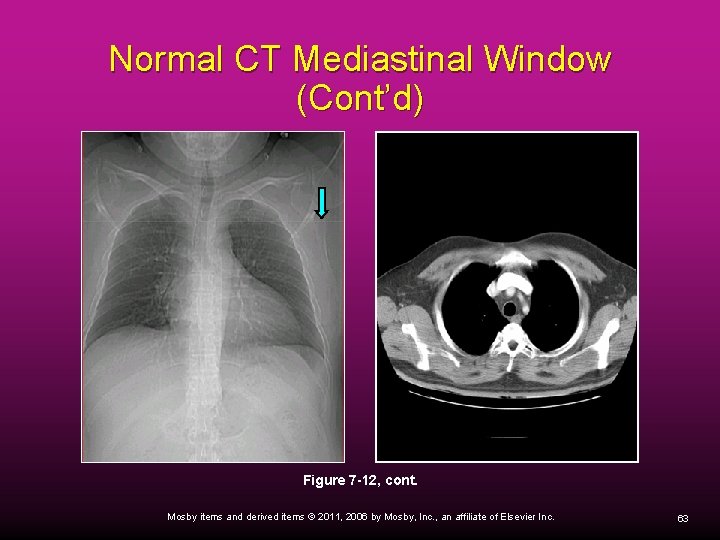 Normal CT Mediastinal Window (Cont’d) Figure 7 -12, cont. Mosby items and derived items