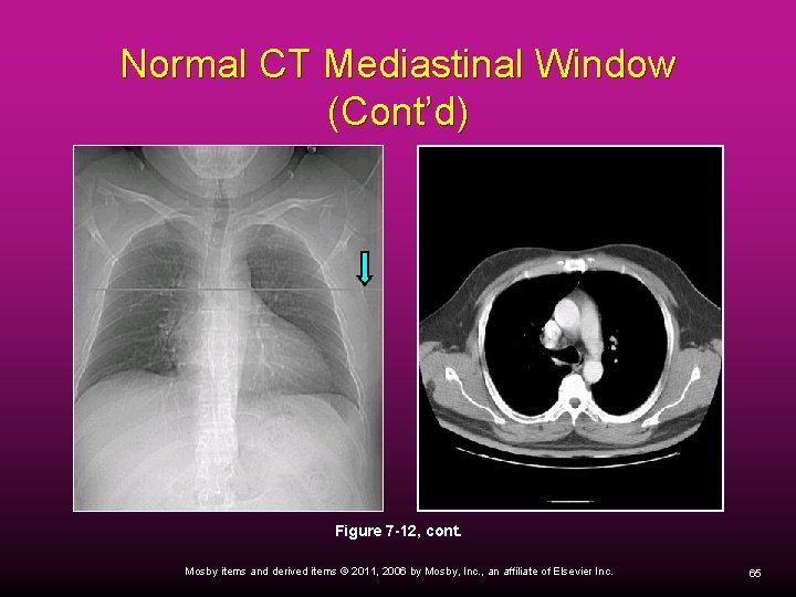 Normal CT Mediastinal Window (Cont’d) Figure 7 -12, cont. Mosby items and derived items