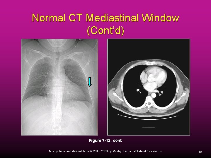 Normal CT Mediastinal Window (Cont’d) Figure 7 -12, cont. Mosby items and derived items