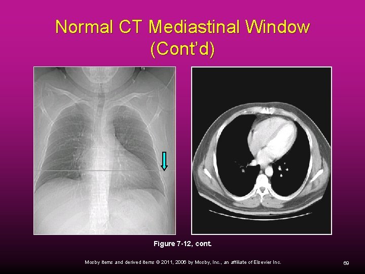 Normal CT Mediastinal Window (Cont’d) Figure 7 -12, cont. Mosby items and derived items