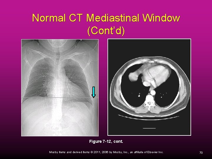 Normal CT Mediastinal Window (Cont’d) Figure 7 -12, cont. Mosby items and derived items