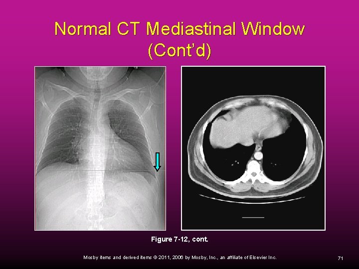 Normal CT Mediastinal Window (Cont’d) Figure 7 -12, cont. Mosby items and derived items