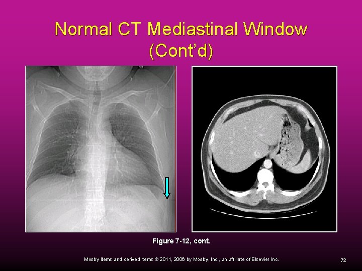 Normal CT Mediastinal Window (Cont’d) Figure 7 -12, cont. Mosby items and derived items