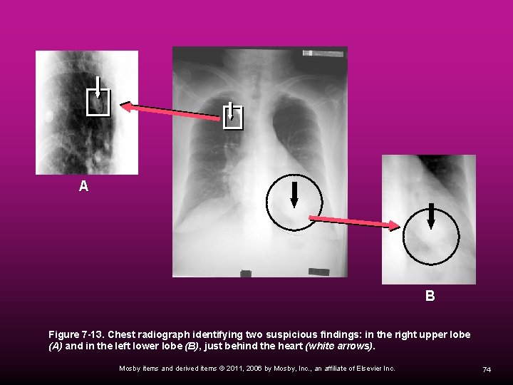 A B Figure 7 -13. Chest radiograph identifying two suspicious findings: in the right