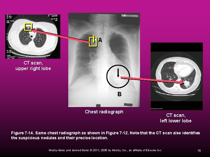 A CT scan, upper right lobe B Chest radiograph CT scan, left lower lobe