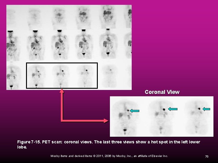 Coronal View Figure 7 -15. PET scan: coronal views. The last three views show