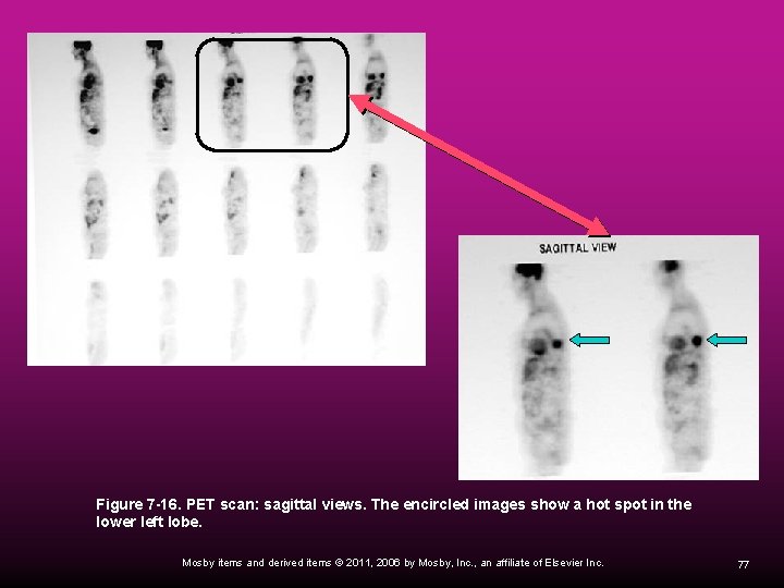 Figure 7 -16. PET scan: sagittal views. The encircled images show a hot spot