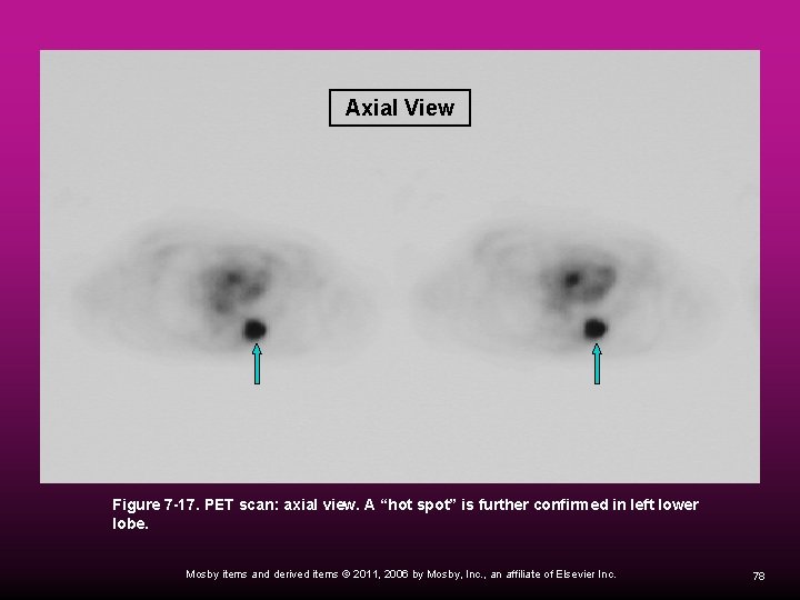 Axial View Figure 7 -17. PET scan: axial view. A “hot spot” is further