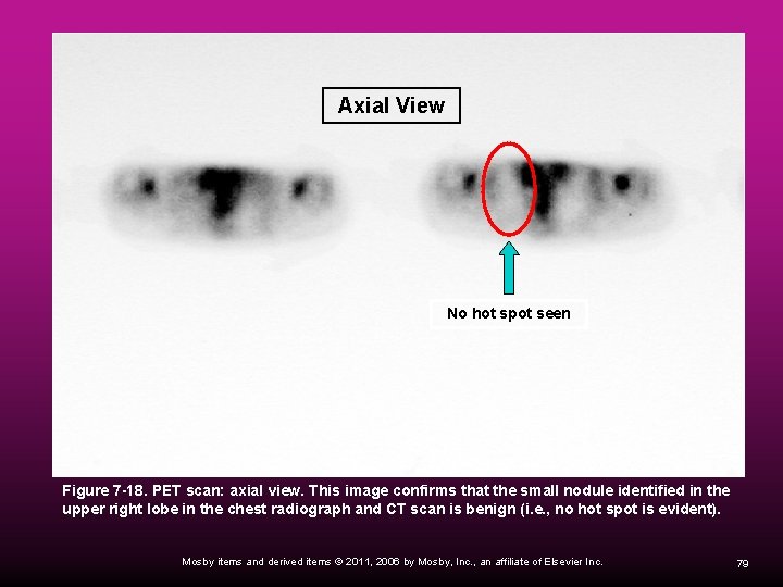 Axial View No hot spot seen Figure 7 -18. PET scan: axial view. This