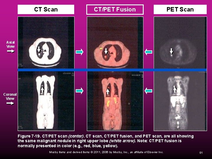 CT Scan CT/PET Fusion PET Scan Axial View Coronal View Figure 7 -19. CT/PET