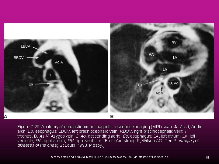  Figure 7 -20. Anatomy of mediastinum on magnetic resonance imaging (MRI) scan. A,