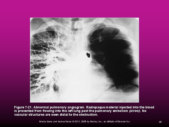  Figure 7 -21. Abnormal pulmonary angiogram. Radiopaque material injected into the blood is