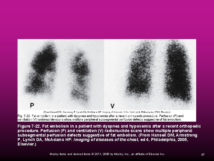  Figure 7 -22. Fat embolism in a patient with dyspnea and hypoxemia after