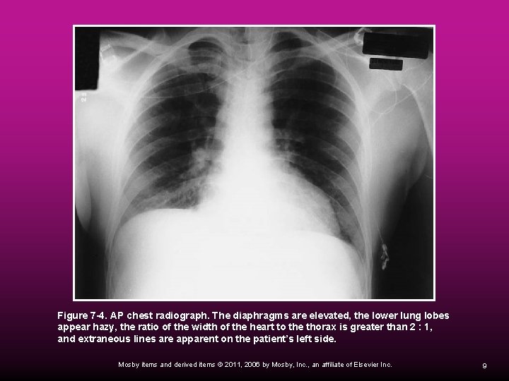  Figure 7 -4. AP chest radiograph. The diaphragms are elevated, the lower lung