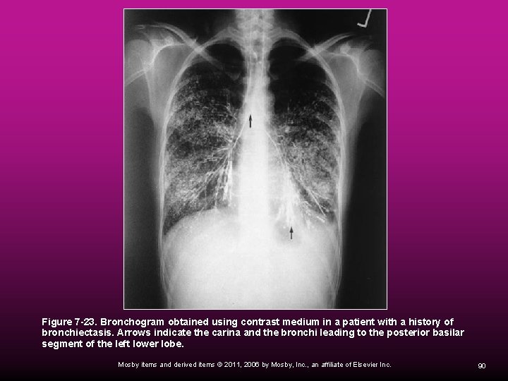  Figure 7 -23. Bronchogram obtained using contrast medium in a patient with a