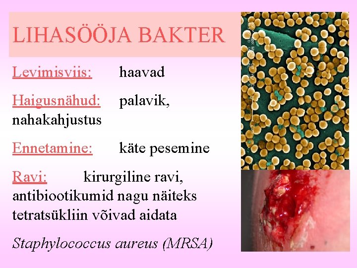 LIHASÖÖJA BAKTER Levimisviis: haavad Haigusnähud: nahakahjustus palavik, Ennetamine: käte pesemine Ravi: kirurgiline ravi, antibiootikumid