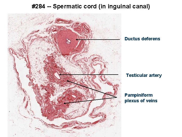 #284 -- Spermatic cord (in inguinal canal) Ductus deferens Testicular artery Pampiniform plexus of