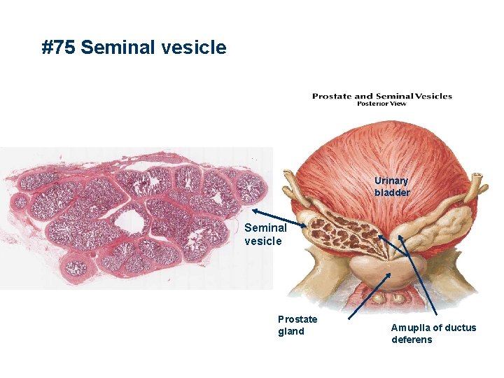 #75 Seminal vesicle Urinary bladder Seminal vesicle Prostate gland Amuplla of ductus deferens 