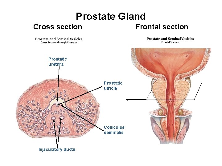 Prostate Gland Cross section Frontal section Prostatic urethra Prostatic utricle Colliculus seminalis Ejaculatory ducts