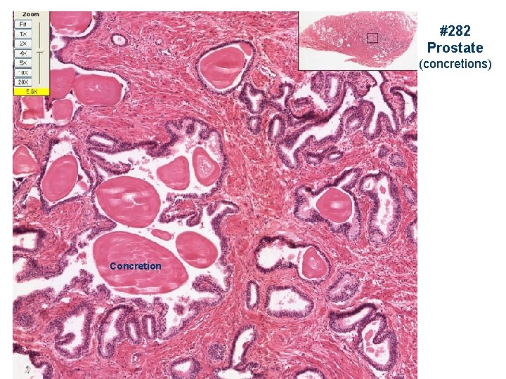 #282 Prostate (concretions) Concretion 