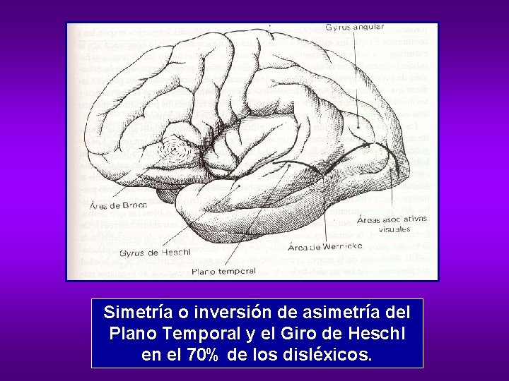 Simetría o inversión de asimetría del Plano Temporal y el Giro de Heschl en