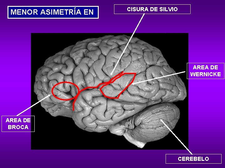MENOR ASIMETRÍA EN CISURA DE SILVIO AREA DE WERNICKE AREA DE BROCA CEREBELO 