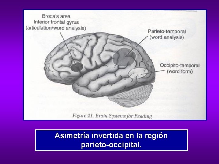 Asimetría invertida en la región parieto-occipital. 