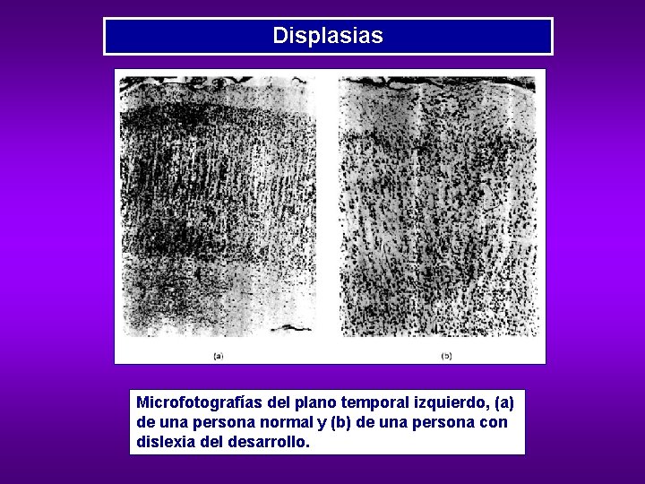 Displasias Microfotografías del plano temporal izquierdo, (a) de una persona normal y (b) de