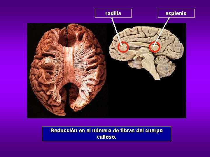 rodilla Reducción en el número de fibras del cuerpo calloso. esplenio 