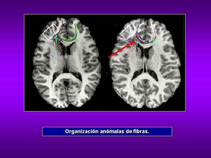Organización anómalas de fibras. 