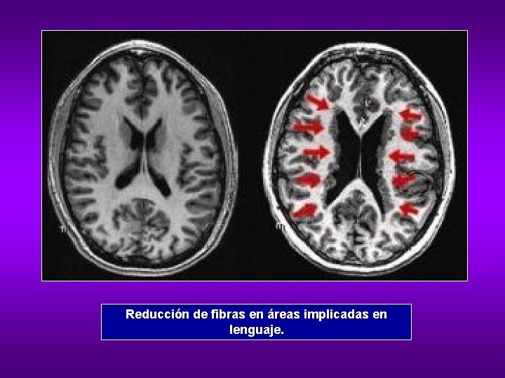 Reducción de fibras en áreas implicadas en lenguaje. 