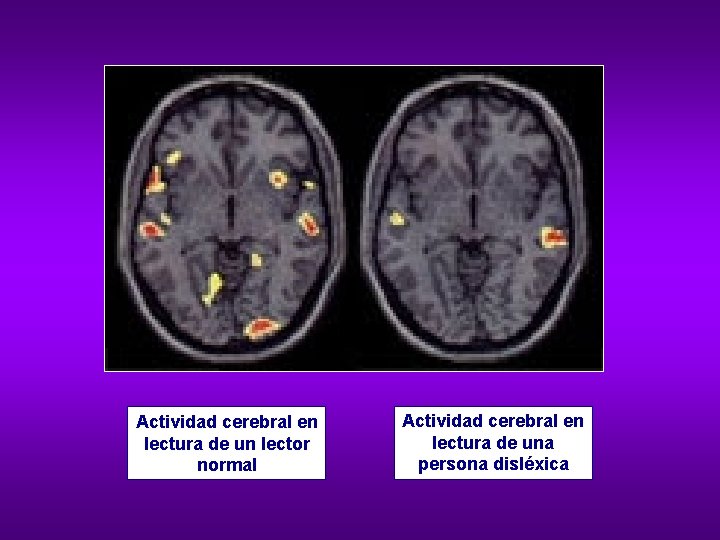 Actividad cerebral en lectura de un lector normal Actividad cerebral en lectura de una