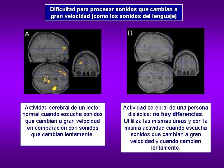 Dificultad para procesar sonidos que cambian a gran velocidad (como los sonidos del lenguaje)