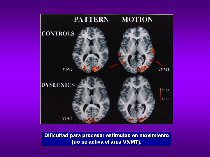 Dificultad para procesar estímulos en movimiento (no se activa el área V 5/MT). 