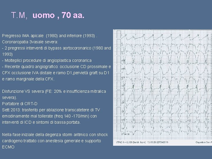 T. M, uomo , 70 aa. Pregresso IMA apicale (1980) and inferiore (1993). Coronaropatia