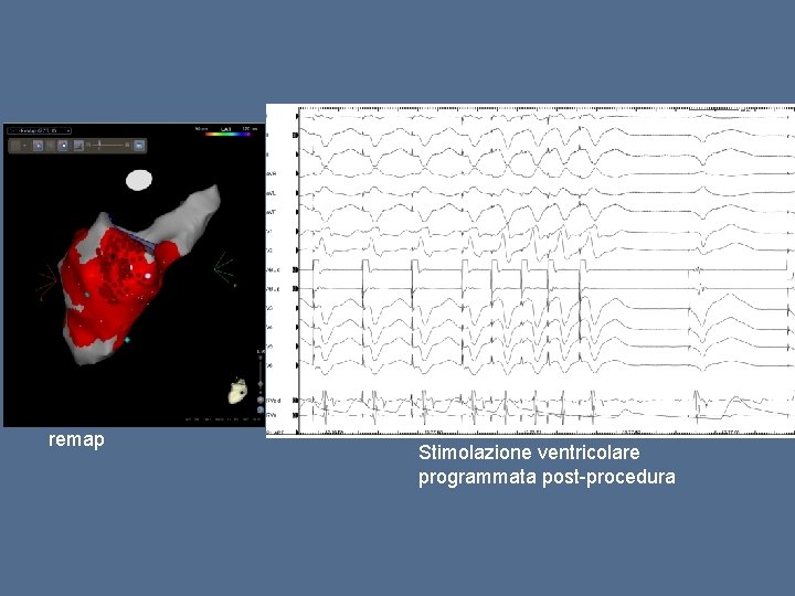remap Stimolazione ventricolare programmata post-procedura 