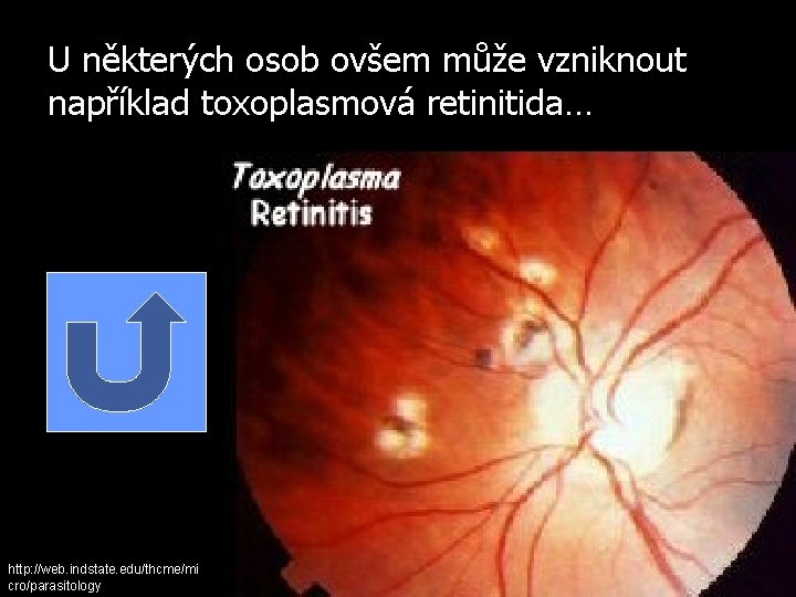 U některých osob ovšem může vzniknout například toxoplasmová retinitida… http: //web. indstate. edu/thcme/mi cro/parasitology